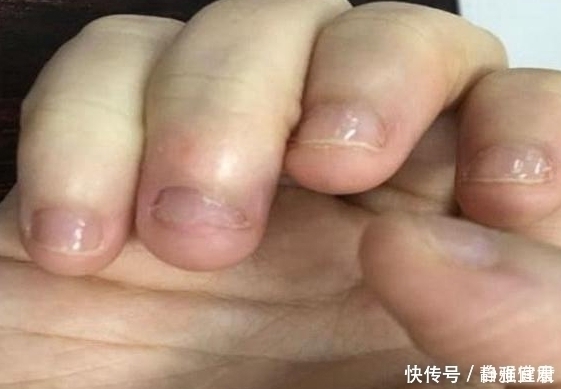 指甲癖|18岁了为什么还啃指甲?有什么办法可以不咬指甲?