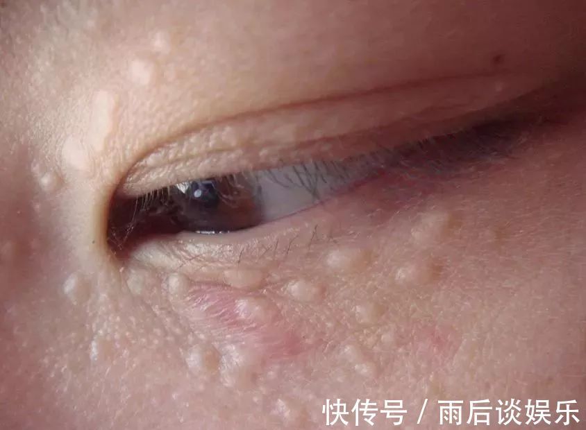 毛周角化|眼睛周围有脂肪粒怎么办?