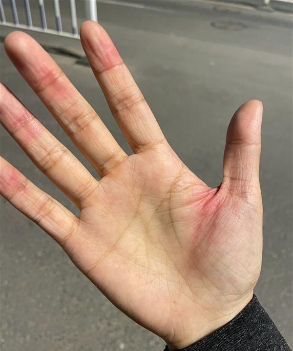 iPhone|多位网友手被割流血!iPhone 12直角边框太凌厉