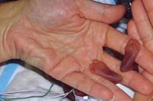 早产儿|还记得那个全世界最小的婴儿吗14年过去了,如今已经完美蜕变