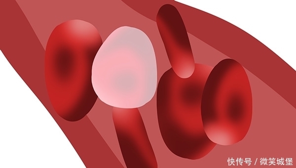 查出高血脂后，坚持日行万步，18年后，身体怎么样了？