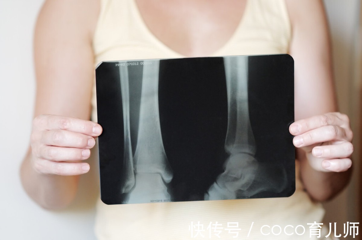 中老年人|提醒中老年人：3类食物或会“加速”骨质疏松，你知道是什么吗？