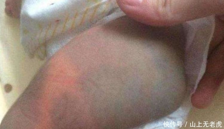 屁股|为什么很多新生宝宝屁股上都有“淤青”?答案在这!快来看看