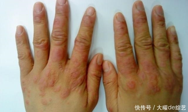 毒素|看“中指”就能看出肝的好坏,若没有这3个现象,那么,肝很健康
