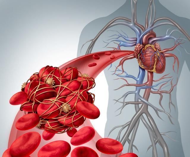 血脂异常|吃木耳能通血管北大教授大错特错,真正能通血管的是这1件事