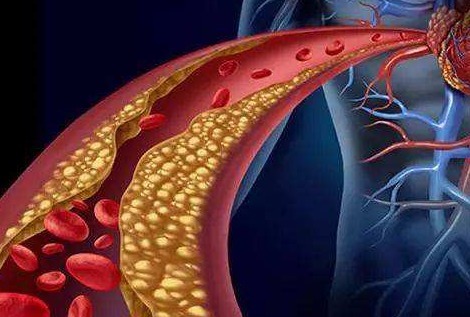 苦荞|溶栓药的“帮手”被找到,每天坚持吃,血管有弹性了,血栓没了
