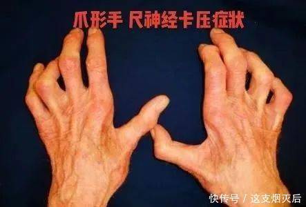 手部麻木的7种常见病因、如何鉴别及治疗