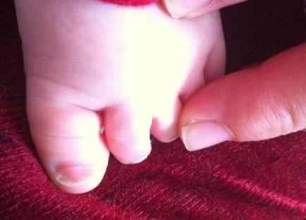 洞洞|5岁孩子双脚变形,只因长时间穿这种鞋子,父母要注意