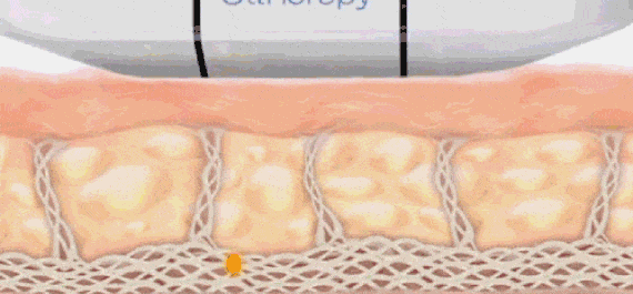 超声提升 热玛吉&超声提升,谁是抗衰NO.1?抗衰选它就对了!