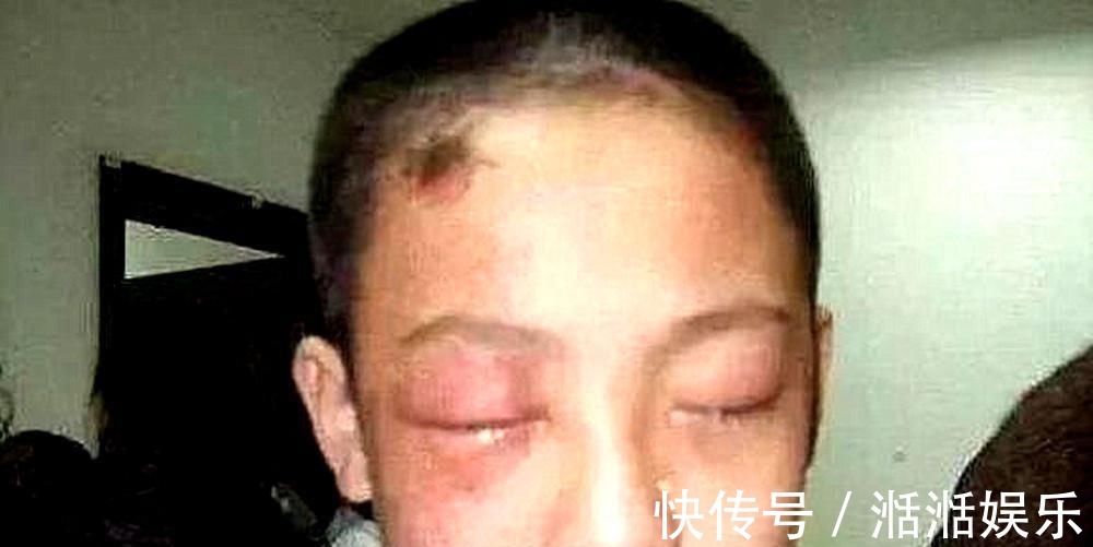 罐子|5岁男娃眼睛被溶,几乎失明!这样的“玩具”,家长别让孩子碰