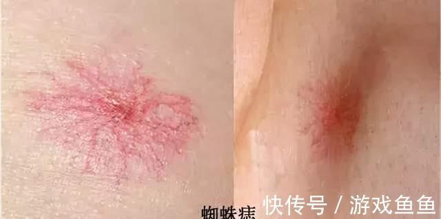 肝腹水|身体三个地方发生变色，糟糕，肝硬化已经悄悄找上你，别大意