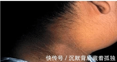 脖子|9岁小女孩脖颈发黑洗不掉,经医院检查后,医生的话却让家长笑了