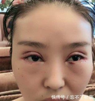 男友|女子被男友嫌弃“猪鼻子”,愤怒整容十几次,现在居然成陌陌女神