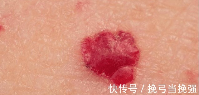 家长|一岁宝宝因“胎记”抢救无效,永远闭上了眼,家长不容忽视!