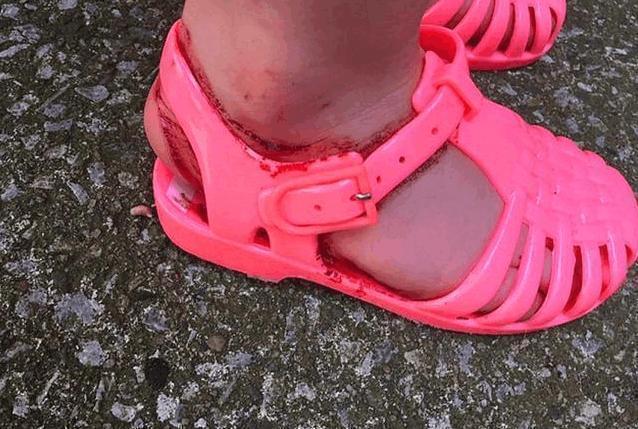 果冻鞋|前有“洞洞鞋”,后有“果冻鞋”,血的教训告诉你为啥别给孩子穿