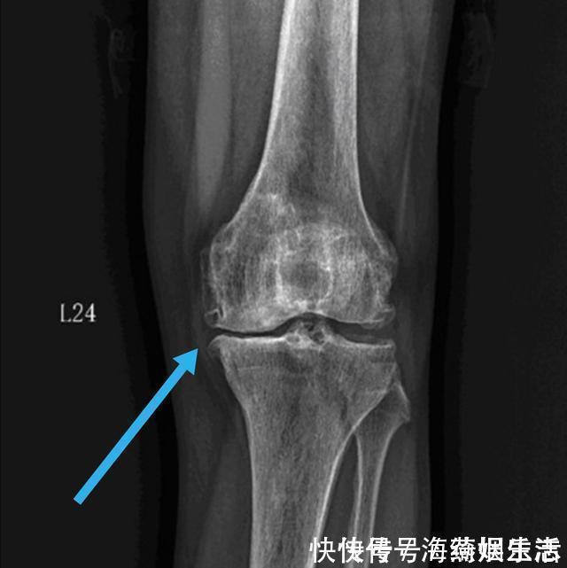 咋回事|膝关节很奇怪,上下楼梯,蹲起蹲起就疼,走平路不疼,咋回事