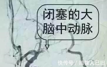 梓醇|中风的“罪魁祸首”是血栓, 记牢两个字血栓不上身
