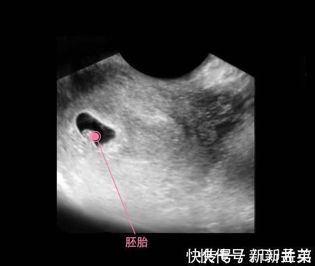 羊水|胎儿从卵泡到性别形成,17张图片清晰诠释,男宝女宝看得很清楚