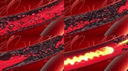 血液浓稠的话身体会有5个表现，坚持4件事，清除血管垃圾