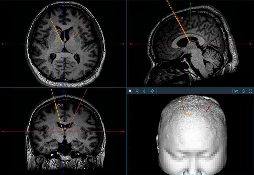治疗|湖南首例“机器人植入脑起搏器治疗难治性癫痫”手术完成