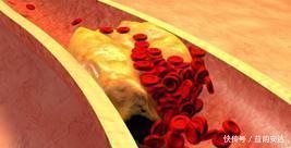 动脉粥样硬化|专家提醒这1物是天然“溶栓王”，一日三杯，血管不堵、不硬