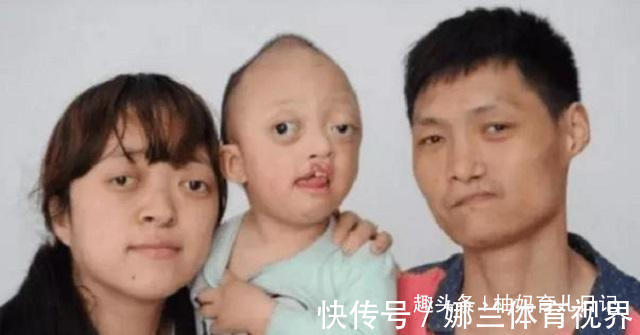 狭颅症|有种遗传叫“屏蔽优点”,三代人的缺点聚一起,丑的别具一格