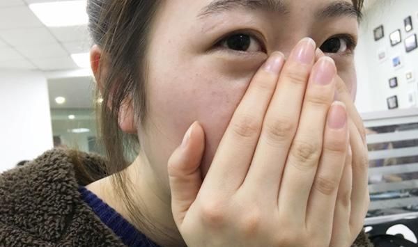 黑头|鼻子里总能挤出的“小白条”是什么？怎么能够快速去除？