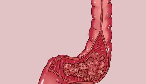 直肠|直肠癌不是突然“偷袭”，大便出现的异常变化，就是“警示”