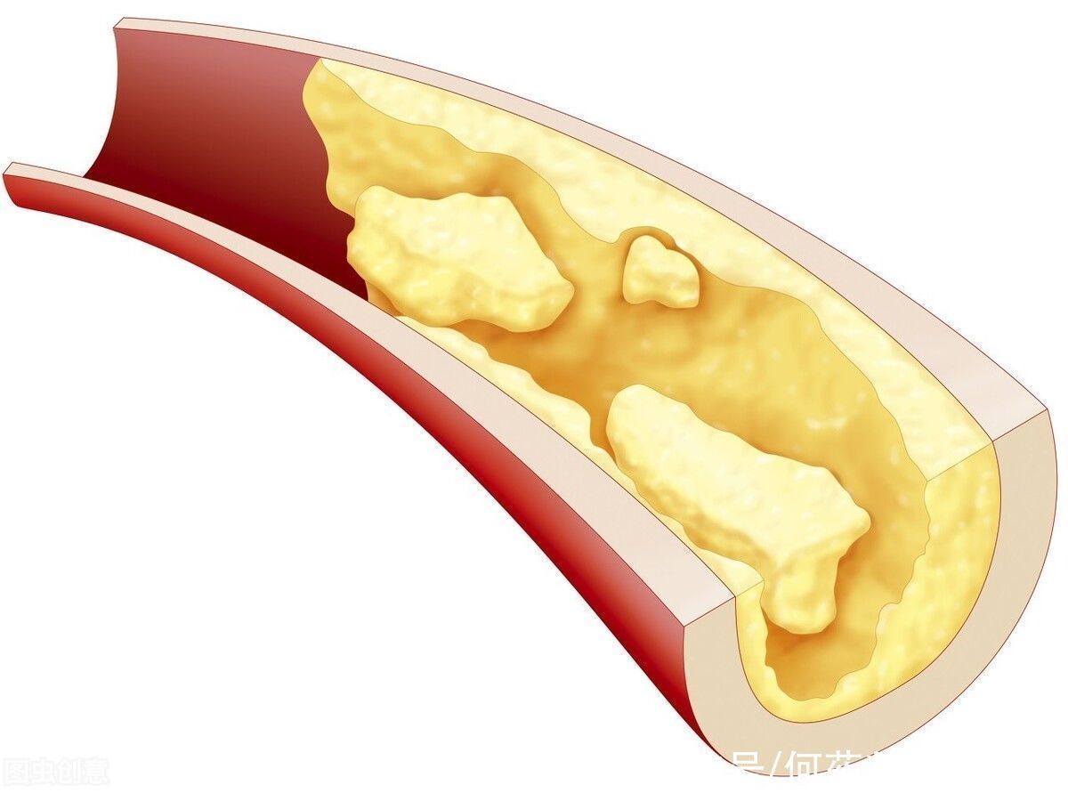 斑块|他汀类从源头上降血脂，缩小和稳定动脉粥样斑块，防止心血管事件
