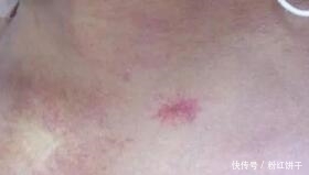 慢性肝炎|身体忽然出现两种痣,可能是你肝脏有问题,要及时排毒素了