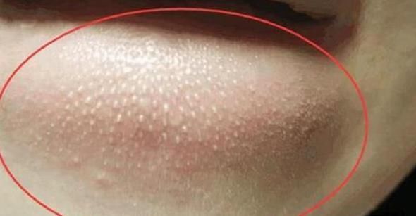 皮脂腺|下巴处的白色“小疙瘩”,到底是什么呢?也许是此在“捣鬼”!