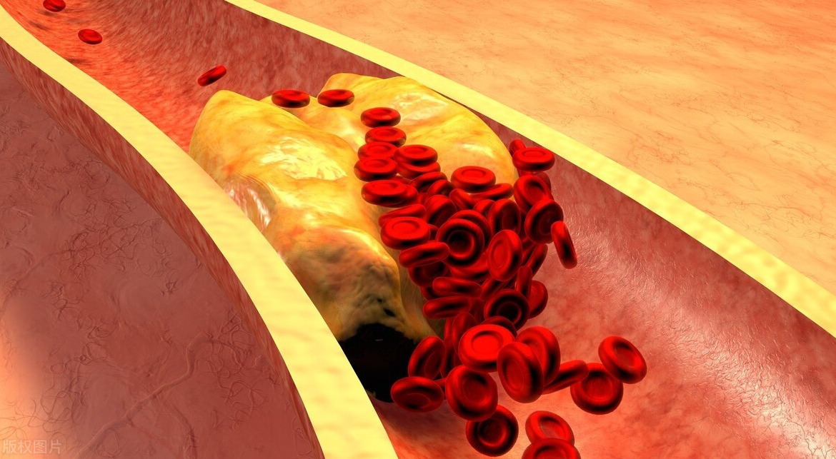 血管|86岁老人甘油三酯1.2，血管干净无淤，“诀窍”在于常吃3物