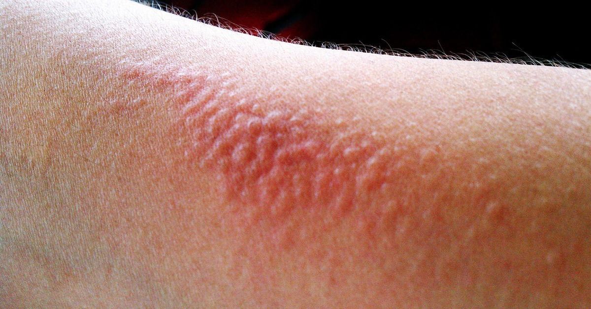 黑棘皮|皮肤上如果出现6个标志,你可能已经患上糖尿病,自己却不知道