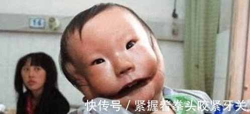 面部|23岁产妇生下一名“面具婴儿”面部断裂害怕人,医生:都是妈妈惹的祸