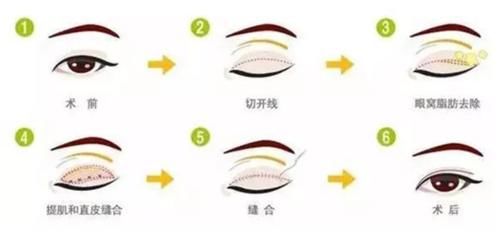 肿眼泡到双眼皮，你需要怎么做？