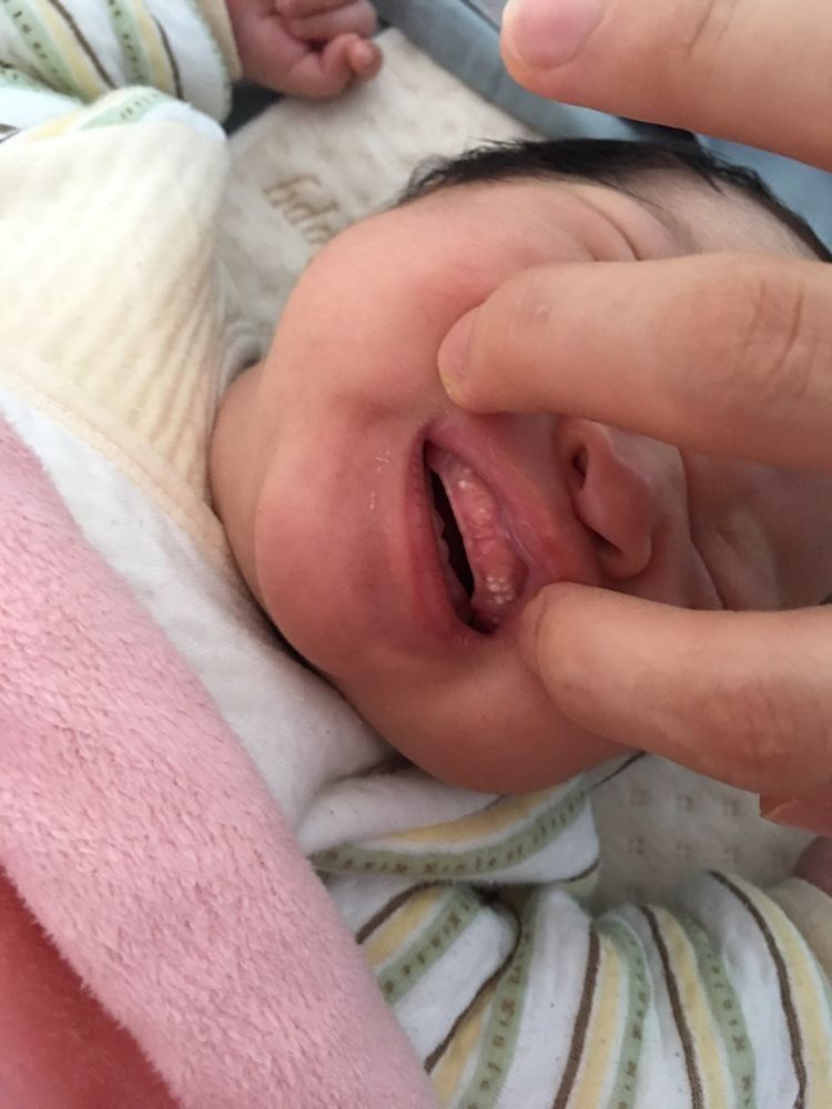 宝宝|女儿生下来就有“2颗牙齿”,婆婆说孩子命苦,儿科医生:拔掉吧