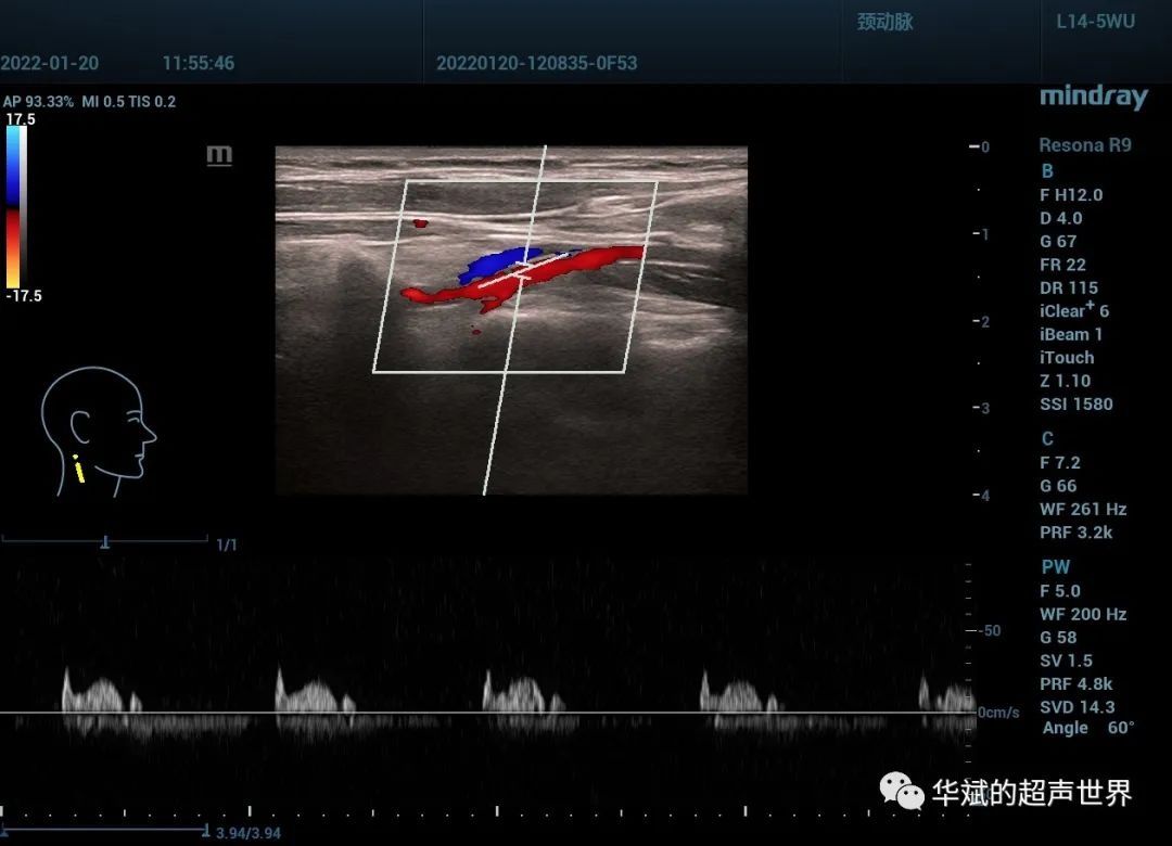 超声检查|典型病例?猎人弓综合征