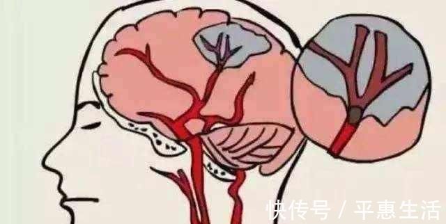 血管|50岁后,有四个习惯的人最易发生脑梗,三个信号能抓住一个就很好