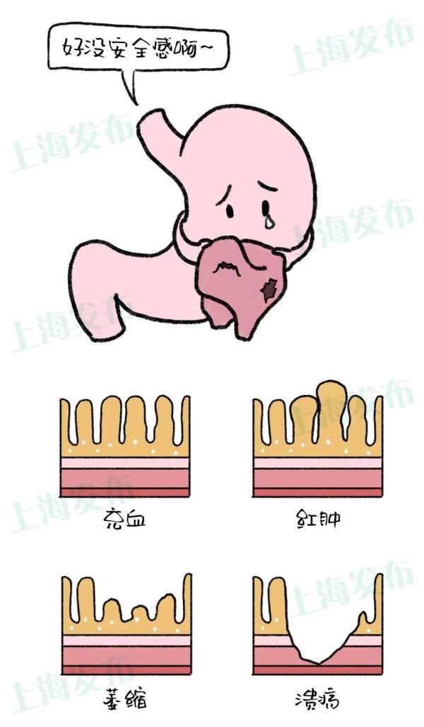 胃液|【医聊】从胃炎到胃癌,胃粘膜扛下了所有~