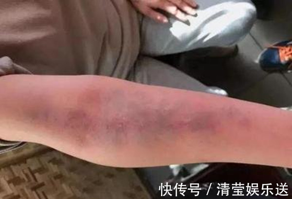 湿气|白水加1物,湿气走光光!祛湿排毒,美容养颜,值得一试!