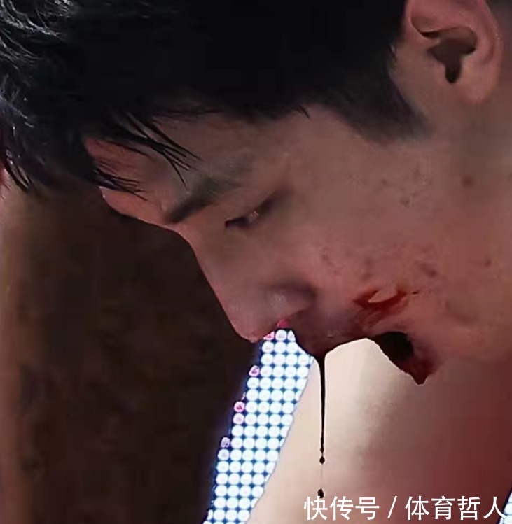 嘴唇|CBA青岛队球员嘴部被肘开,画面触目惊心,医院治疗缝了12针