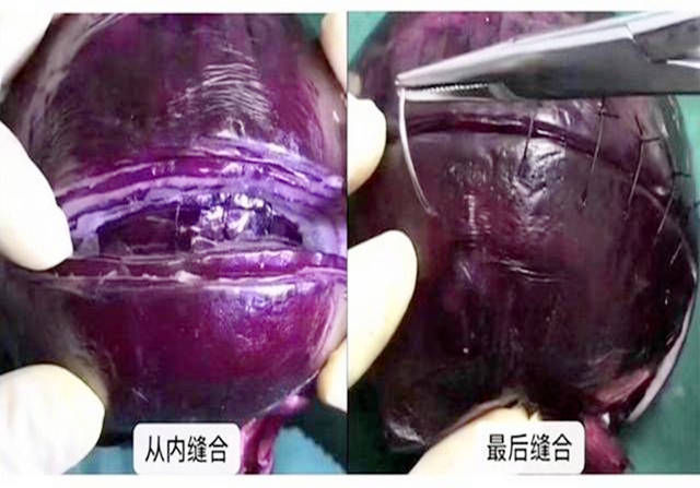 麻药|剖腹产仅是“蚂蚁蜇一下”看完这个洋葱,才明白受罪才刚开始