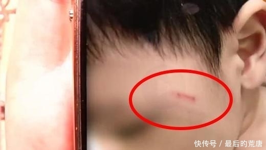 领到|孩子脸上出现伤痕,还被老师领到监控盲区?家长:不接受道歉!