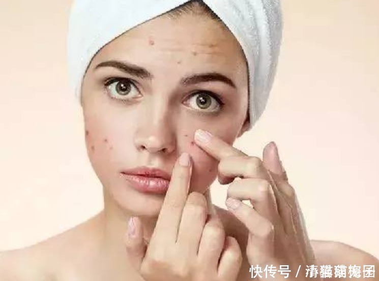 脸上痘痘反复长很困恼别怕!教你5个方法,帮你快速清除痘痘!