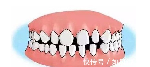 正畸|儿童做牙齿矫正三个最佳时间家长要牢记,矫治越早干预效果越好