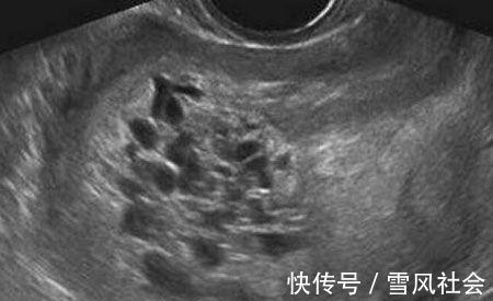 葡萄胎|怀孕女子嫌产检麻烦,5个月后才到医院,结果肚子里全是小蝌蚪