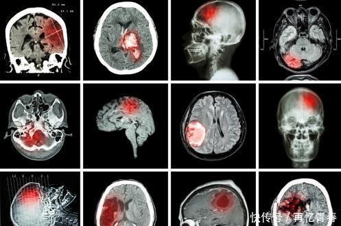 医生|47岁男子脑梗离世，生前爱吃一物，医生：吃一次等于喝一碗油