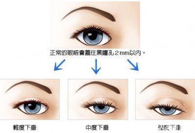 重睑术是什么?俗称割双眼皮,双眼皮手术