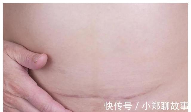 产后抑郁|分娩日记14没有羊水+绕颈两圈,胎盘功能三级,立即插队剖腹产
