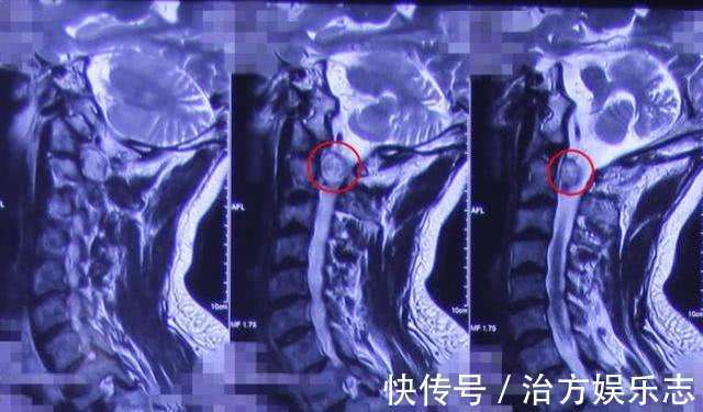 手麻|37岁女子手麻,以为是颈椎病,医院检查颈椎里有个鸡蛋大的肿瘤